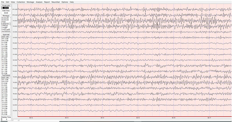 Laplacian montage eyes-open pre-training baseline